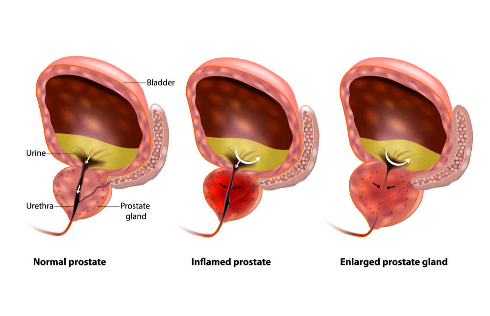 Is An Enlarged Prostate A Serious Medical Condition McIver Clinic